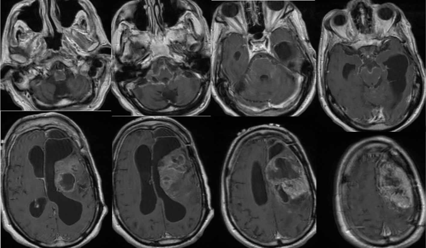 GBM Subarachnoid Subependymal